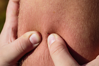 bee sting