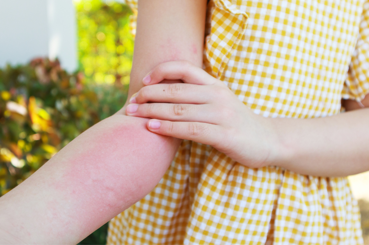 bug bite rash 