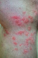 fire ant bites