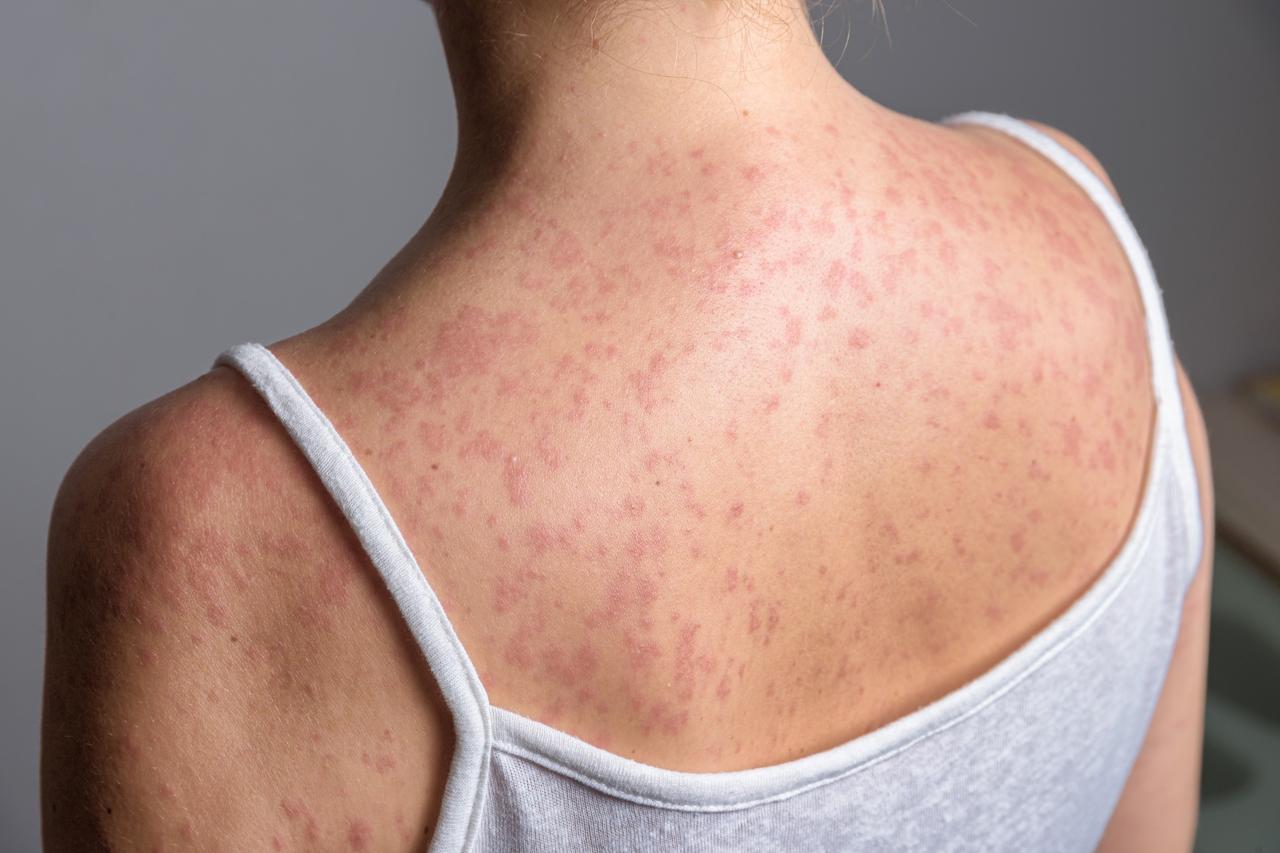 Red skin rash on back