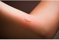 mosquito bite