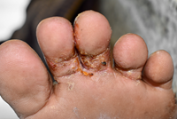 scabies