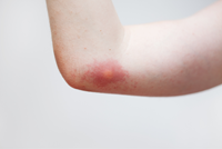wasp sting